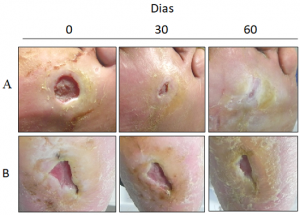 Imagens mostrando a comparação entre plantas do pé com lesões tratadas com a biomembrana (caso A) e com tratamento convencional (caso B), pelo Grupo de Pesquisa “Biotecnologia Molecular de Látex Vegetal”  da Universidade Federal do Ceará (Foto Divulgação)